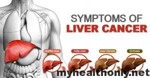 Know about symptoms of liver cancer - My Health Only