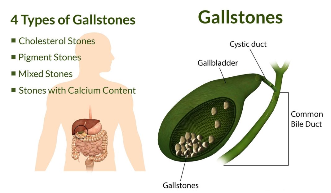 signs gallbladder issues