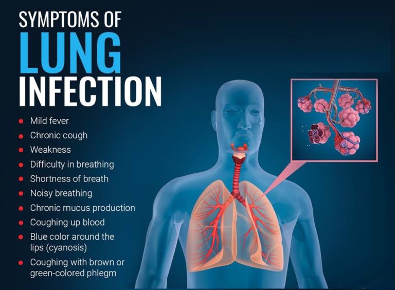 5 Signs and Symptoms of lung infection - My Health Only