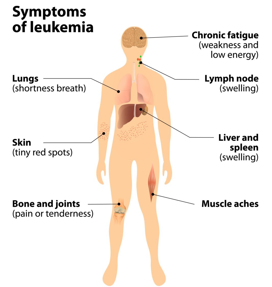 what are symptoms of leukemia
