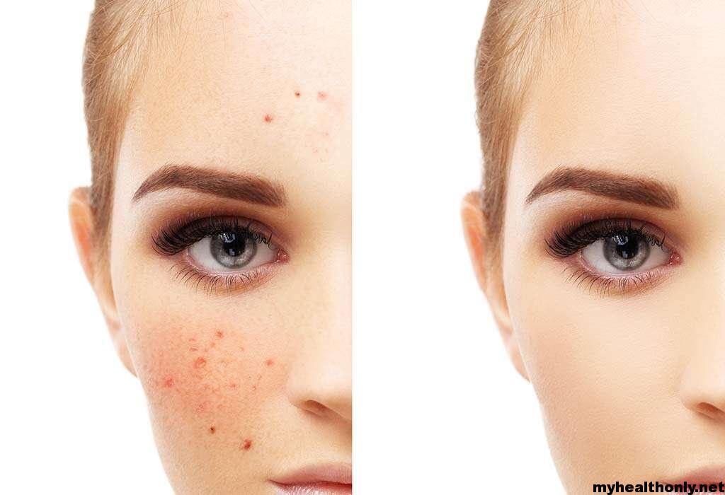 Home Remedies for Freckles