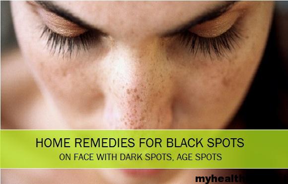 Home Remedies for Dark Spots