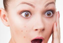 Best Home Remedy for Acne.. Home remedy for acne