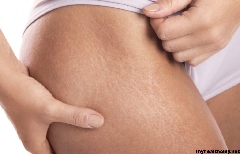 How to Remove Stretch Marks