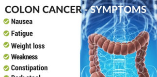 Symptoms of Colon Cancer Symptoms of Colon Cancer