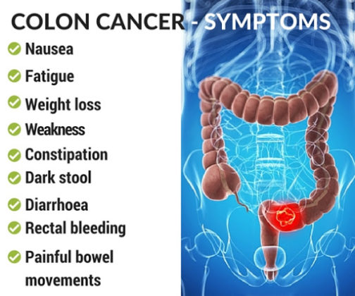 symptoms-of-colon-cancer-risk-factors-and-causes-my-health-only