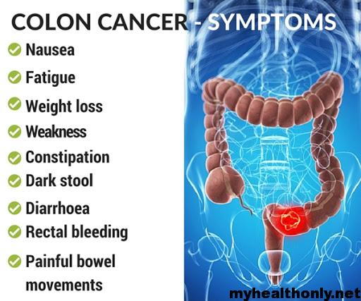 Symptoms of Colon Cancer, Risk Factors and Causes - My Health Only