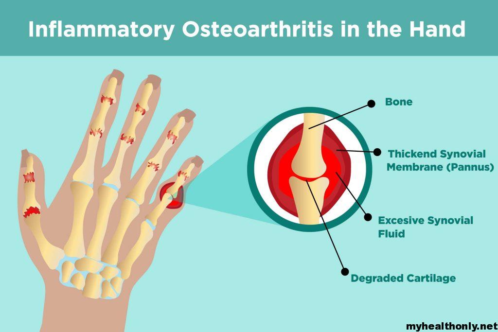 Osteoarthritis Treatment, Causes, Symptoms & Diagnosis