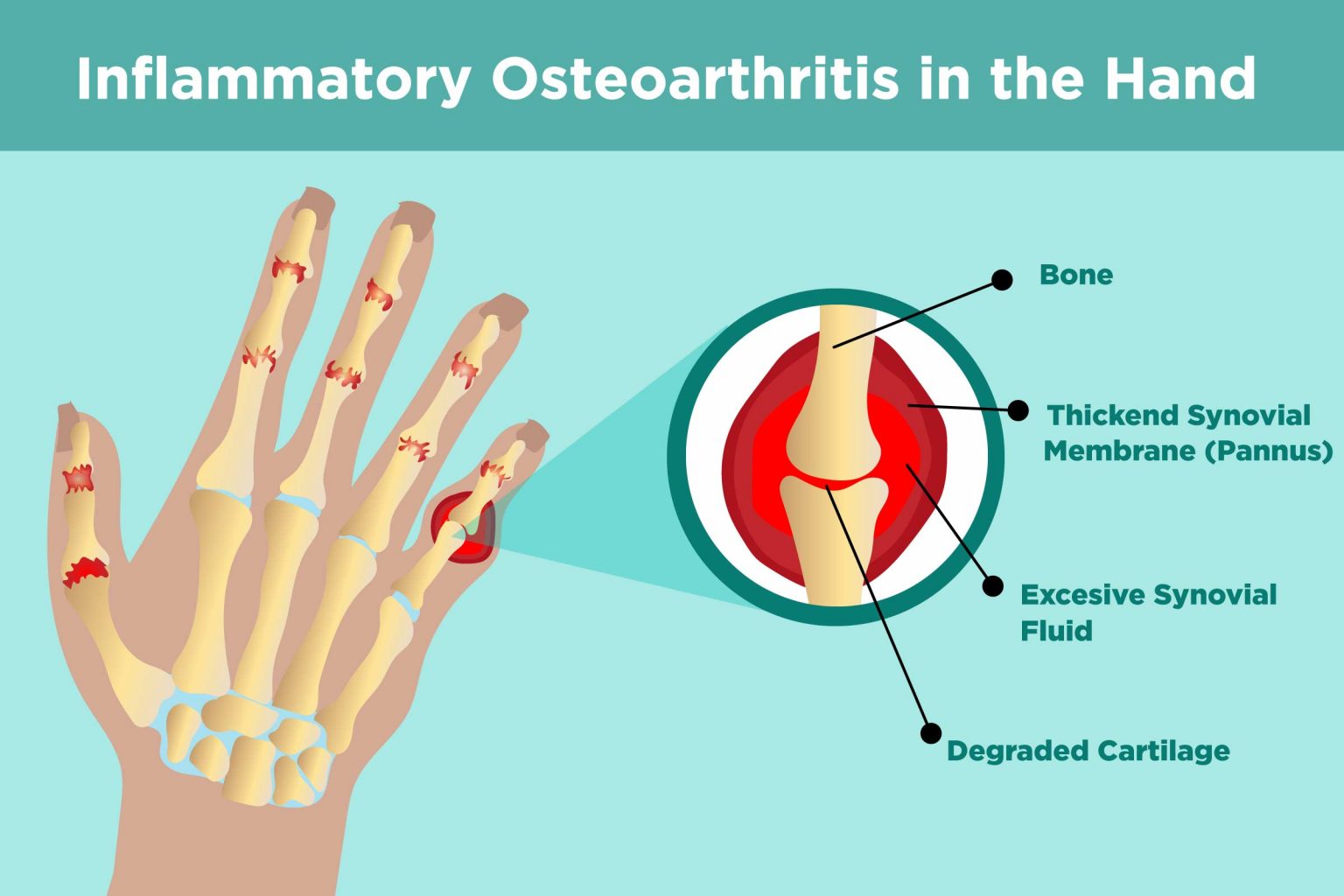 Osteoarthritis Treatment Causes Symptoms And Diagnosis My Health Only 