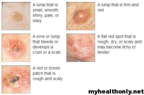 Symptoms of Skin Cancer, Risk Factors, Signs & Causes