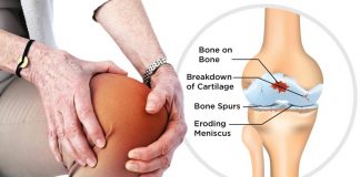 Osteoarthritis Treatment, Causes, Symptoms & Diagnosis
