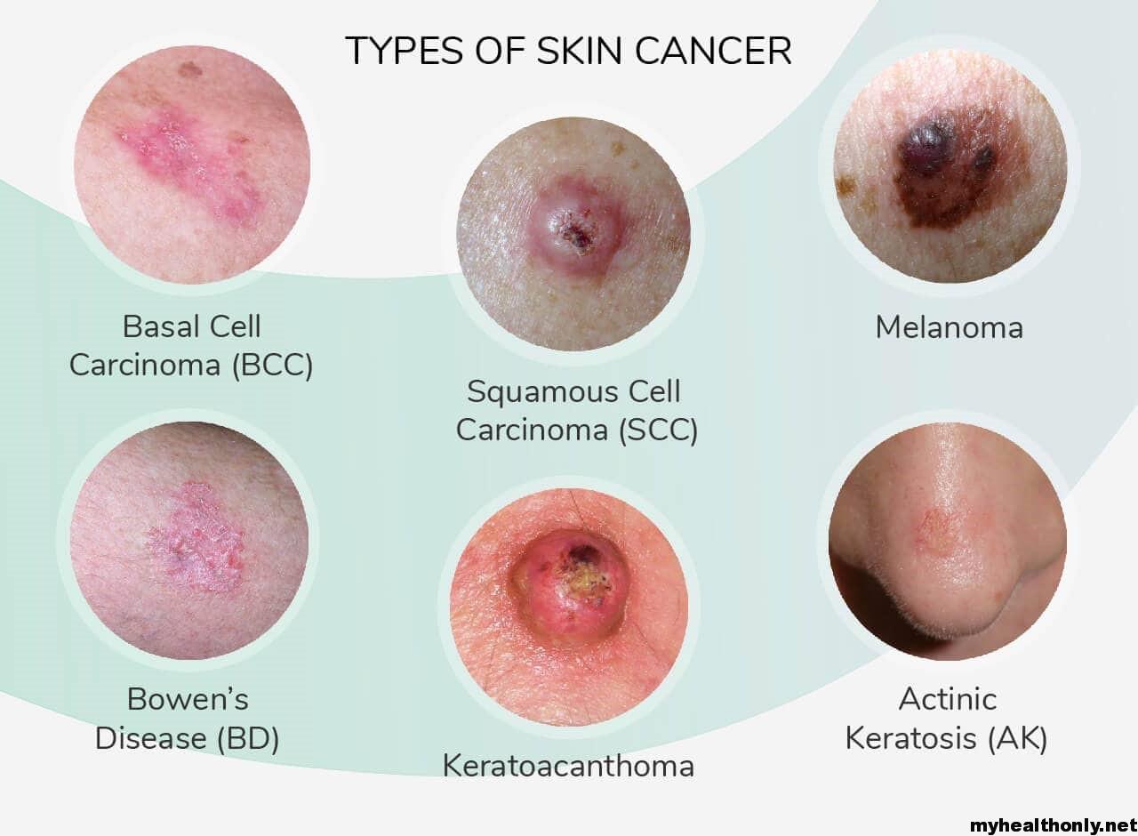 Types Of Skin Cancer 1 ?v=1588272404