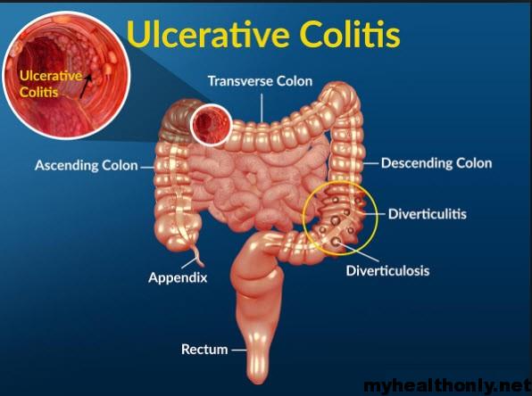 Inflammation of the small intestine (Ulcerative Colitis)