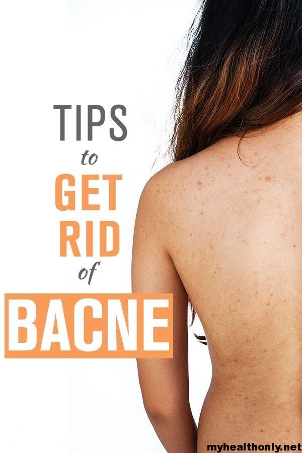 Home Remedies for Back Acne