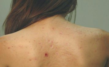 Treatment for Back Acne