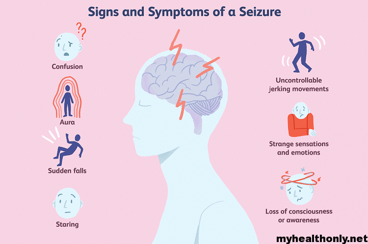 Symptoms of Seizures: Causes, Prevention & Diagnosis - My Health Only