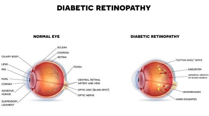 What is diabetic retinopathy