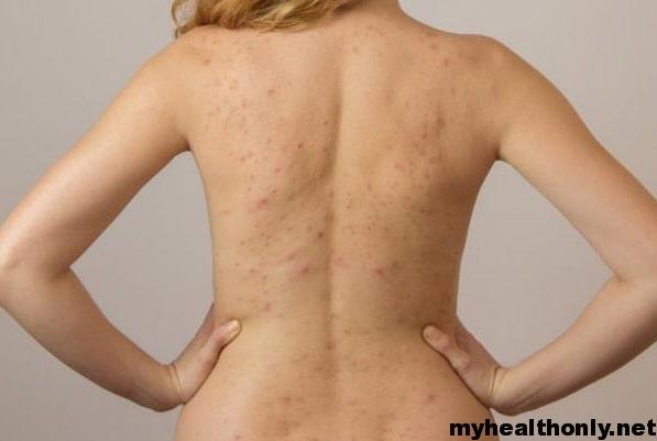 Treatment for Back Acne: Types, Causes & Prevention tips.