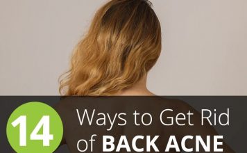 Home Remedies for Back Acne