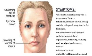 Symptoms of Myasthenia Gravis
