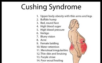 Cushing syndrome - Types, Symptoms, Causes & Treatment