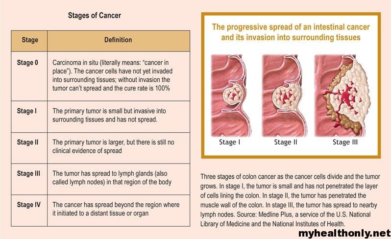 Stage of cancer