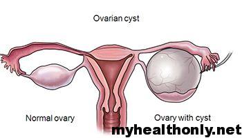 Ovarian cysts are terrible