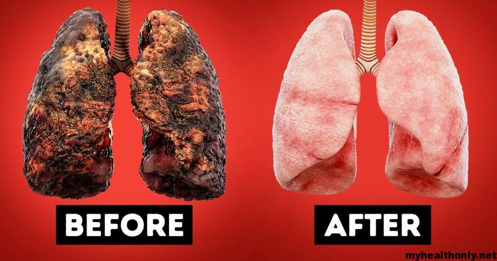 Smokers Lungs Vs Healthy Lungs