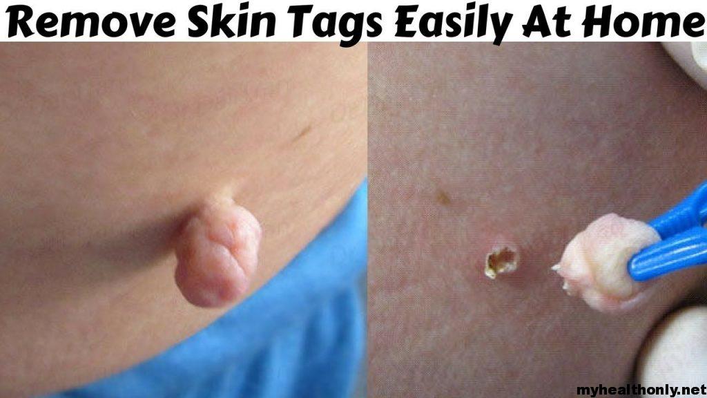 Skin Tags Removal Home Remedies
