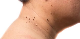 Home Remedies To Remove Skin Tags