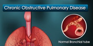 Chronic obstructive pulmonary disease (COPD)
