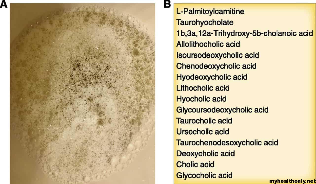 Foamy Urine Causes, Symptoms, Diagnosis & Treatment My Health Only