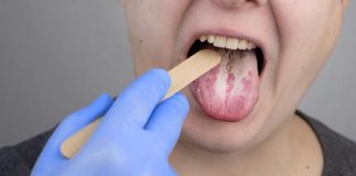 Home Remedies for Oral Thrush