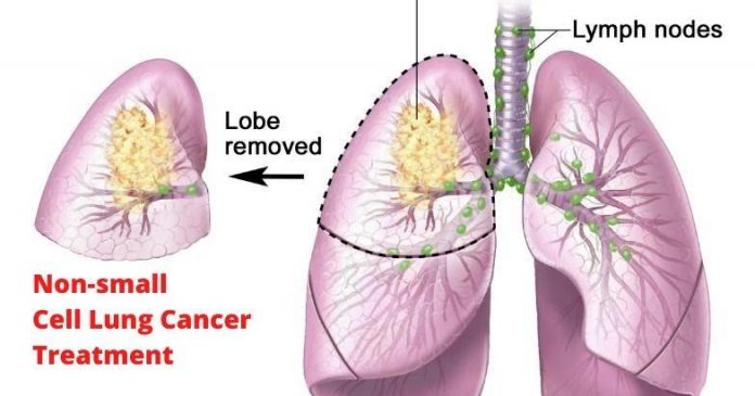 Non-Small Cell Lung Cancer Treatment