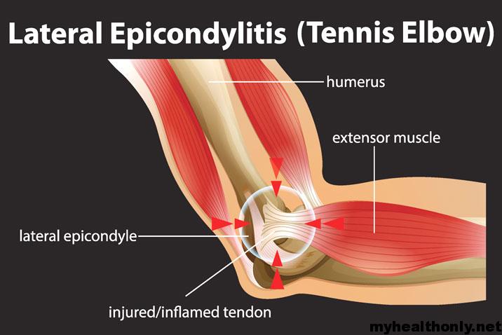 Tennis Elbow | Causes, Symptoms & Treatment