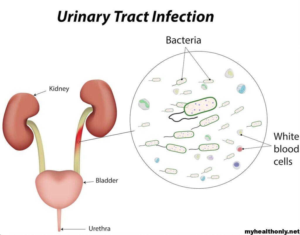 Easy & Effective Home Remedies For Urinary Tract Infection
