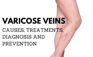 Varicose Veins: Causes, Symptoms and Treatment