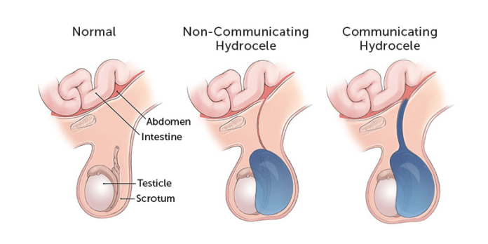 Hydrocele : Treatment, Causes & Symptoms