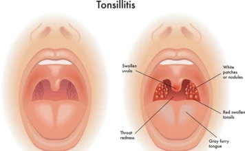 What Is Tonsillitis?