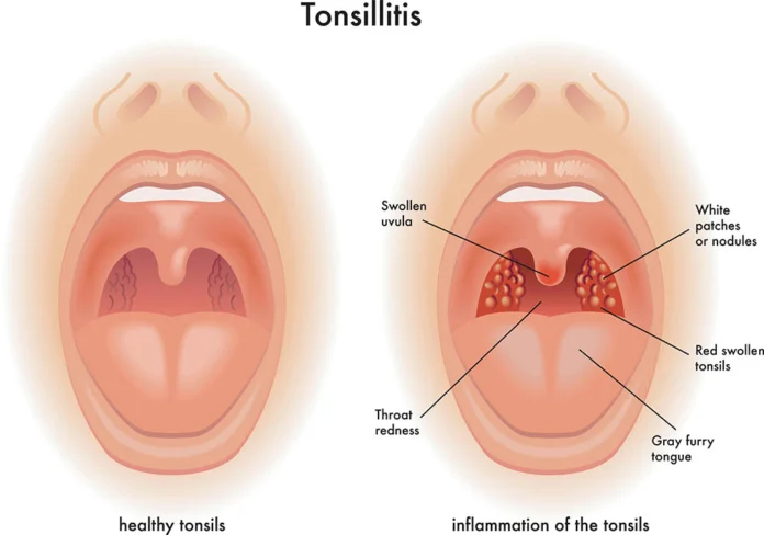 What Is Tonsillitis?