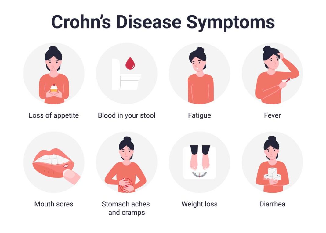 What Is Crohns Disease Its Symptoms And Treatment 5638