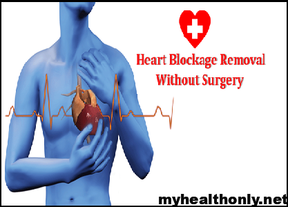 Heart Blockage: 12 Best Home Remedies