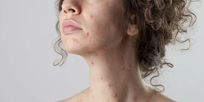 Fade chickenpox scars: Tips for reducing appearance of chickenpox scars.