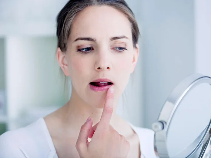 Keep the area clean: Wash your face and lips gently with a mild cleanser twice a day. Avoid scrubbing the affected area harshly, as it can further irritate the skin.