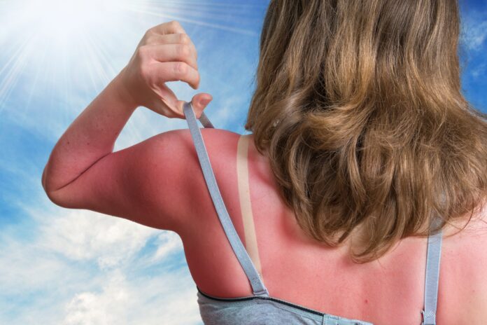Comparison between Sunburn and Sun Poisoning: Understanding the differences and symptoms associated with excessive sun exposure. Alt text for an image or graphic providing information on sun-related skin conditions.
